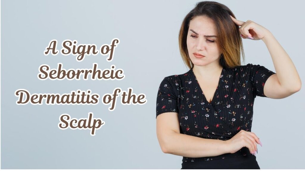 a sign of seborrheic dermatitis of the scalp