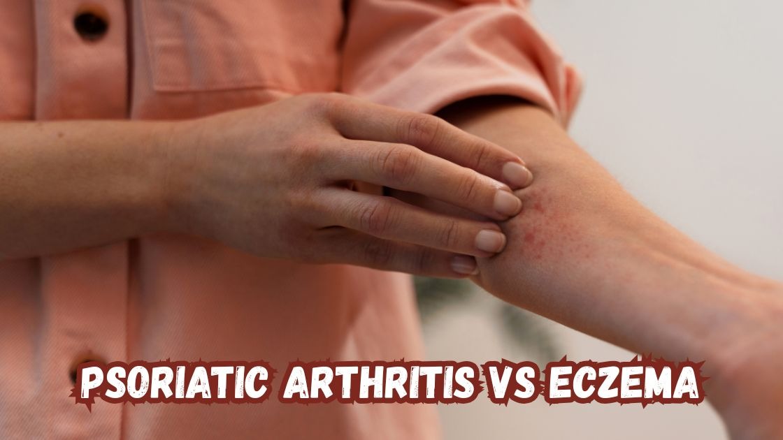 psoriatic arthritis vs eczema