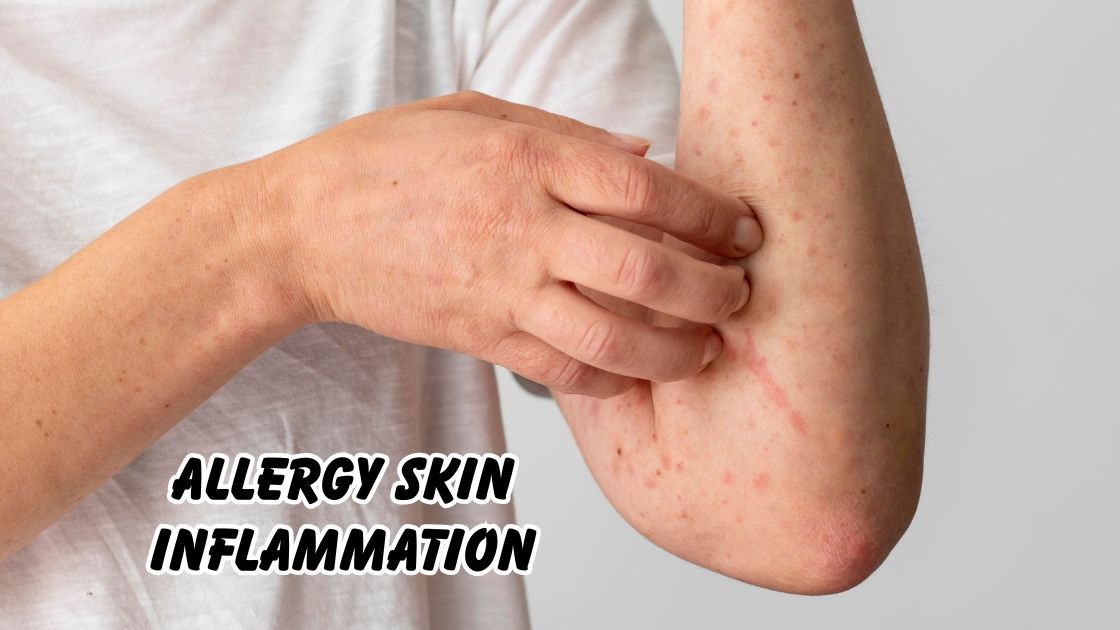 Allergy skin inflammation