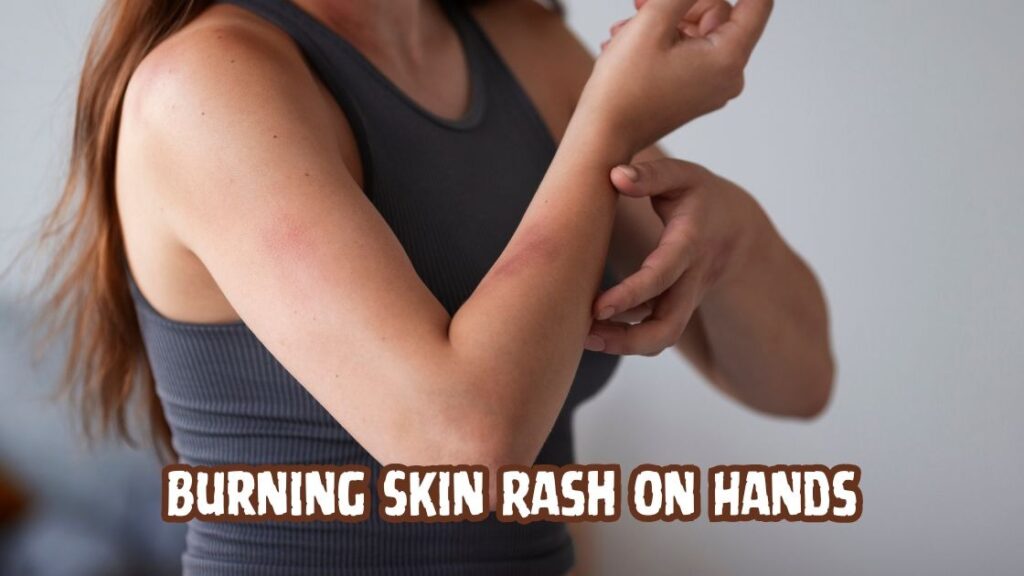 burning skin rash on hands