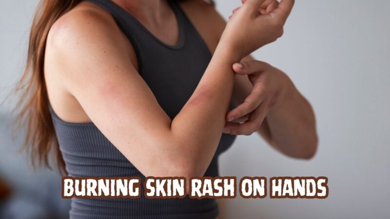 burning skin rash on hands