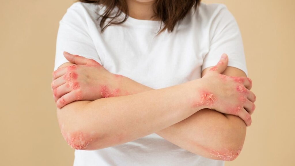 severe eczema