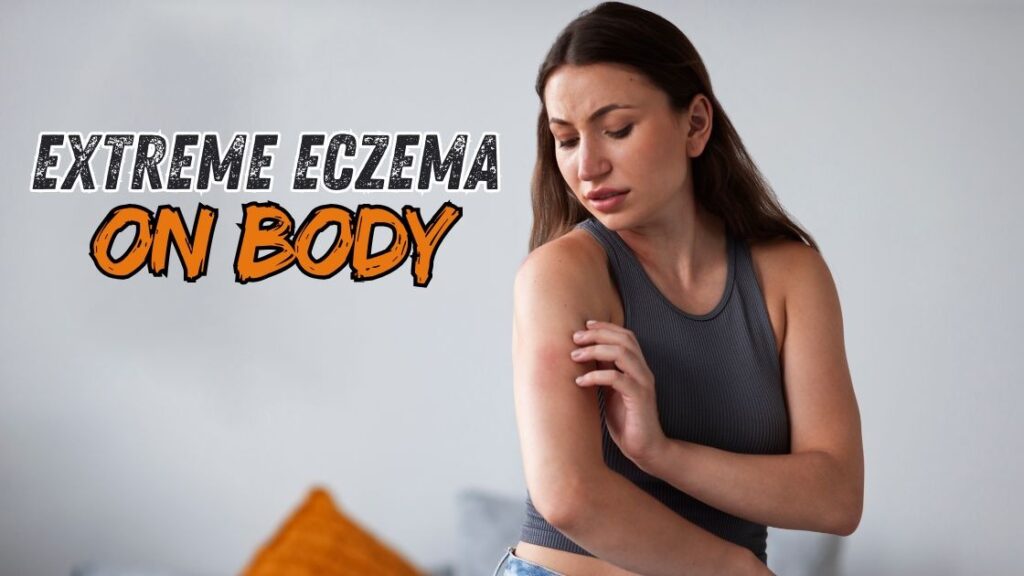 extreme eczema on body