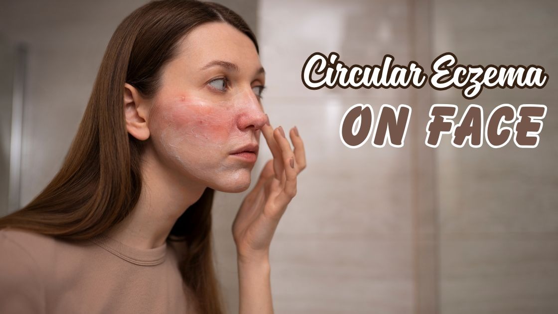 Circular eczema on face
