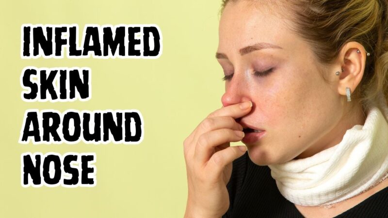 Inflamed skin around nose