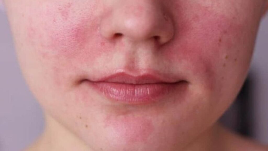 facial redness