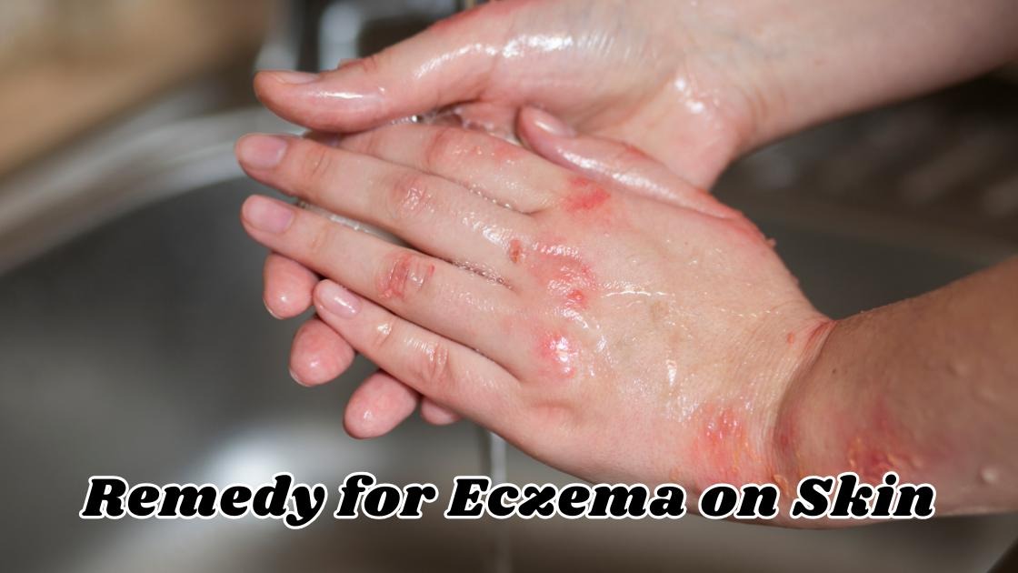 remedy for eczema on skin