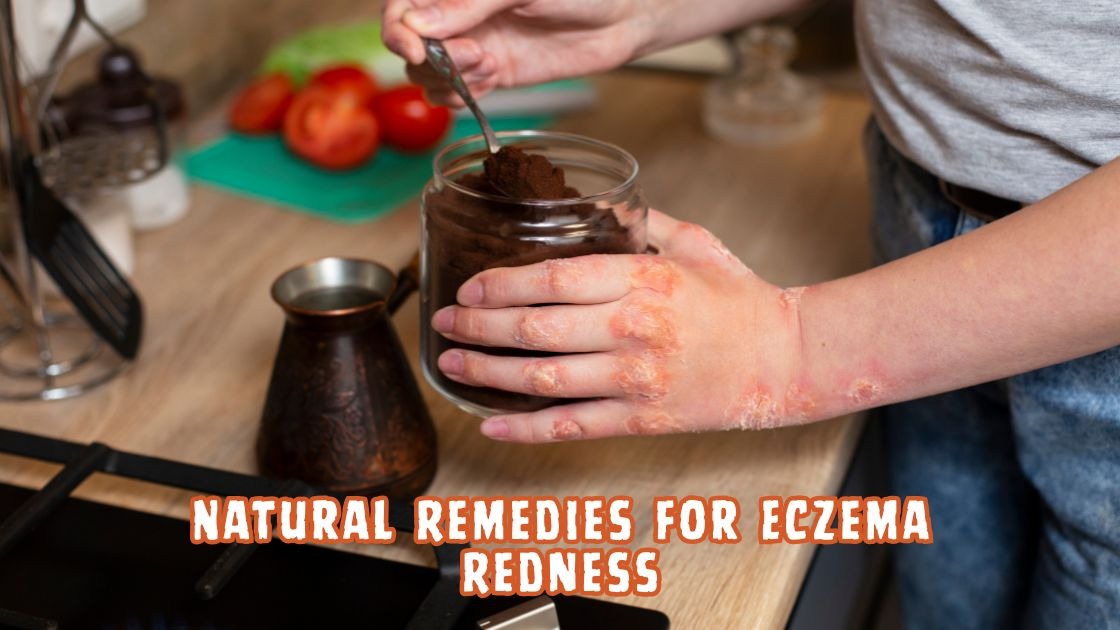 natural remedies for eczema redness