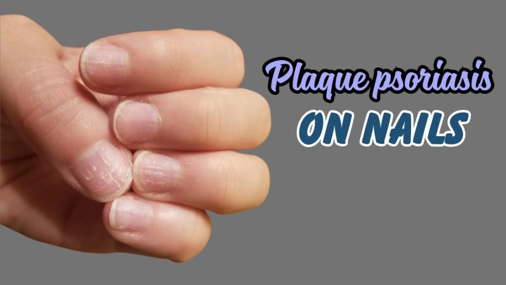 Plaque psoriasis on nails