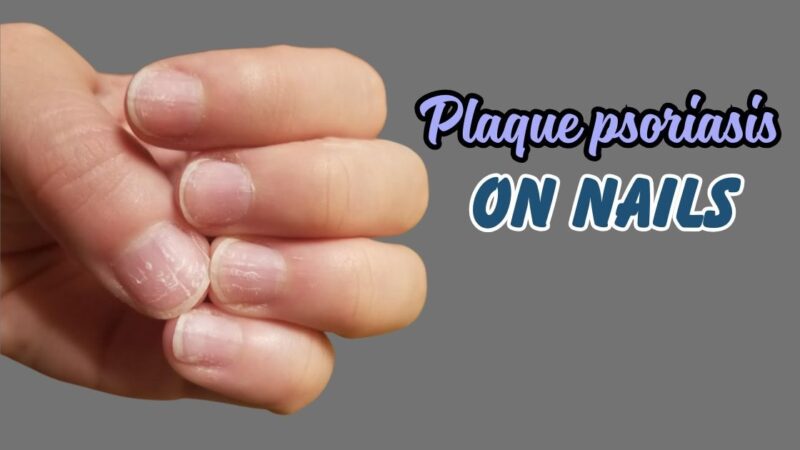 Plaque psoriasis on nails