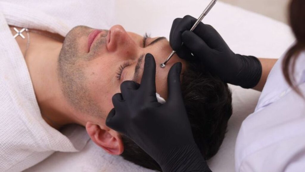 microdermabrasion