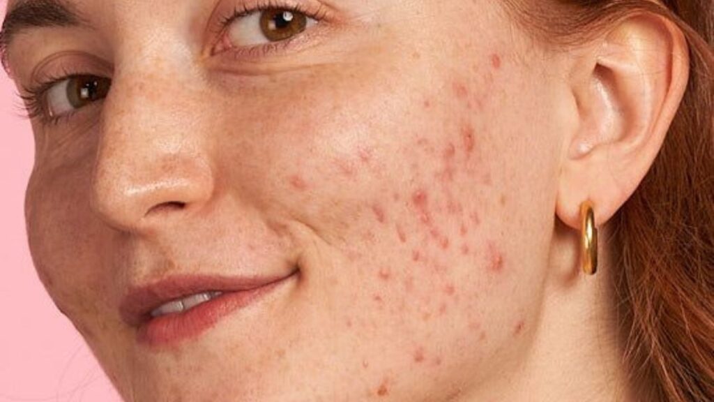 Acne and marks