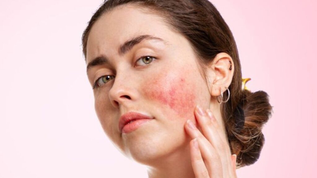 chronic skin condition