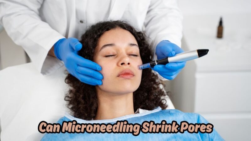 can microneedling shrink pores