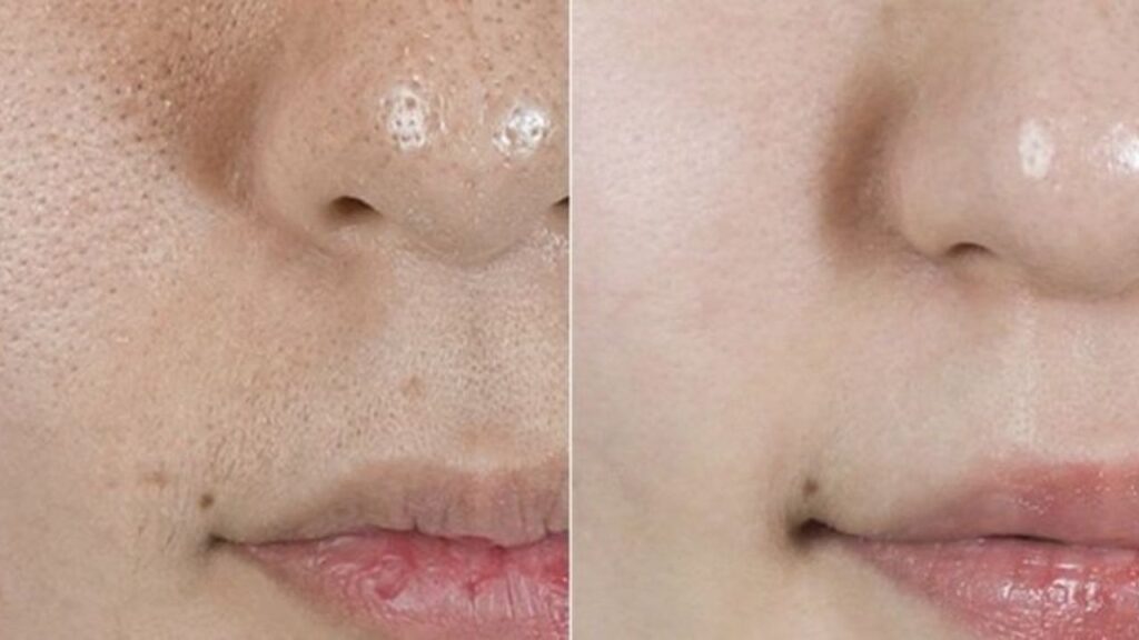 inflammation and breakouts