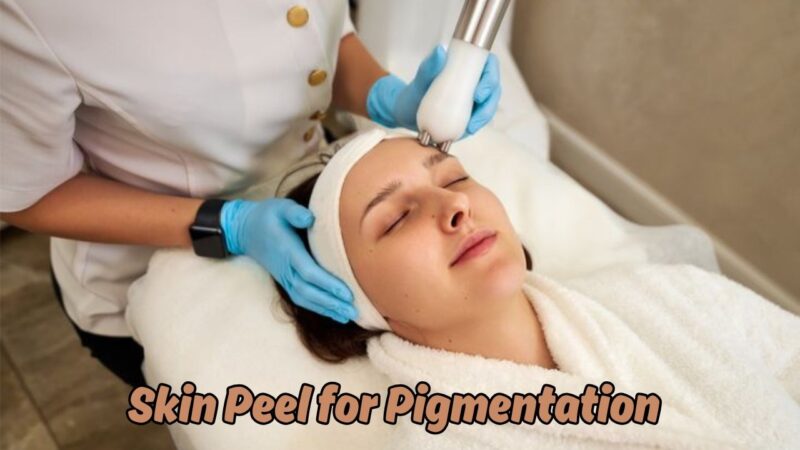 skin peel for pigmentation