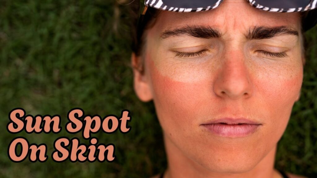 sun spot on skin 