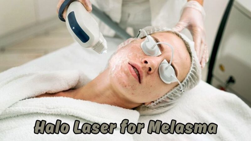 Halo laser for melasma