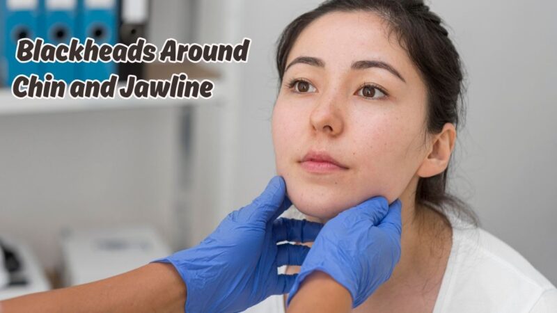 blackheads around chin and jawline