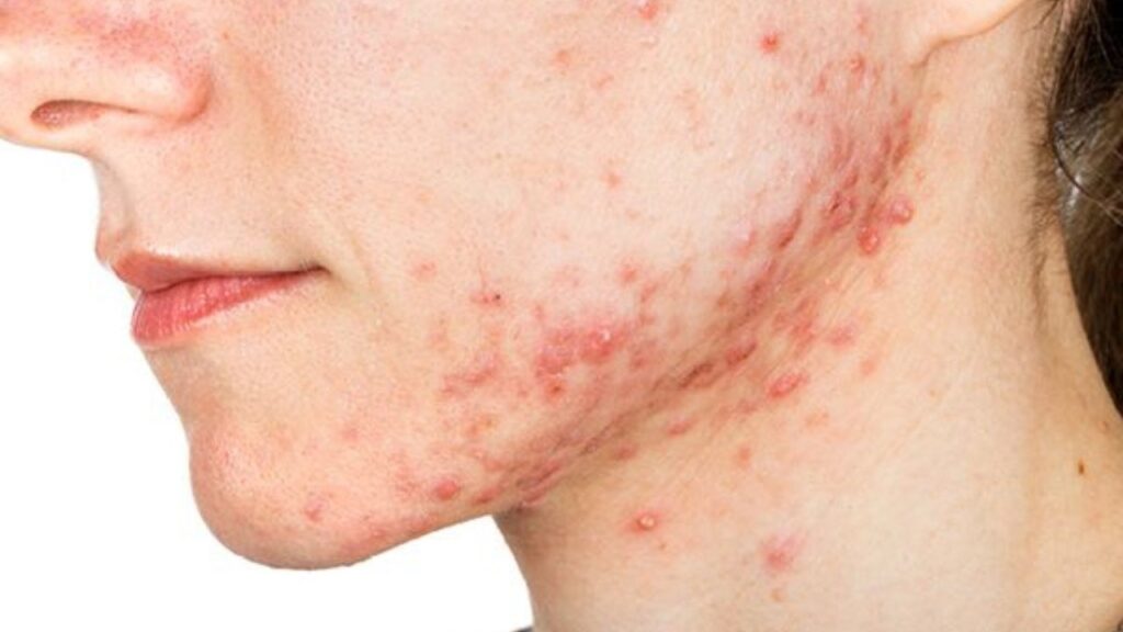adult acne
