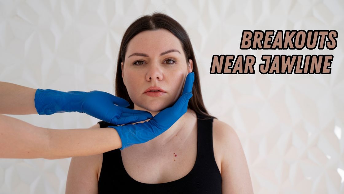 breakouts near jawline
