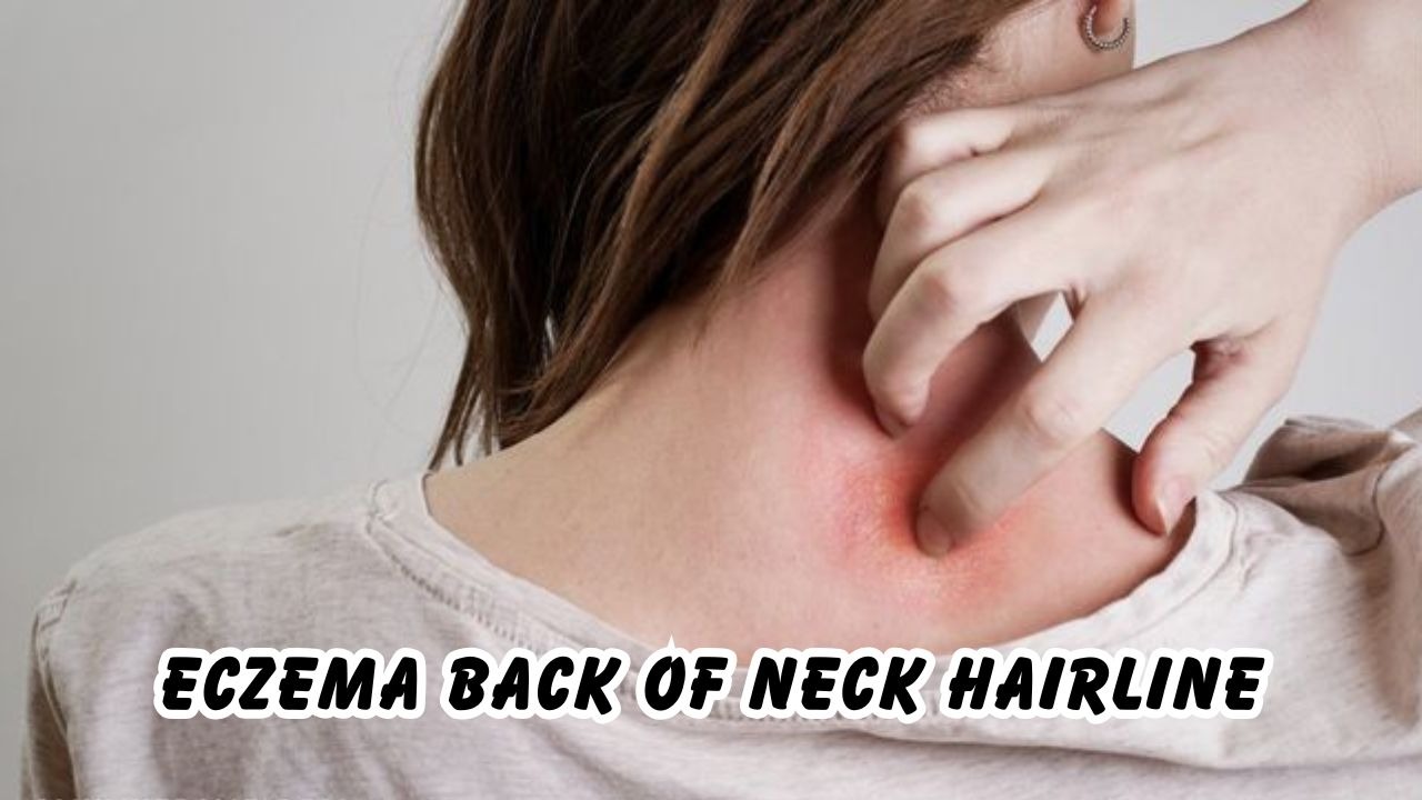 eczema back of neck hairline