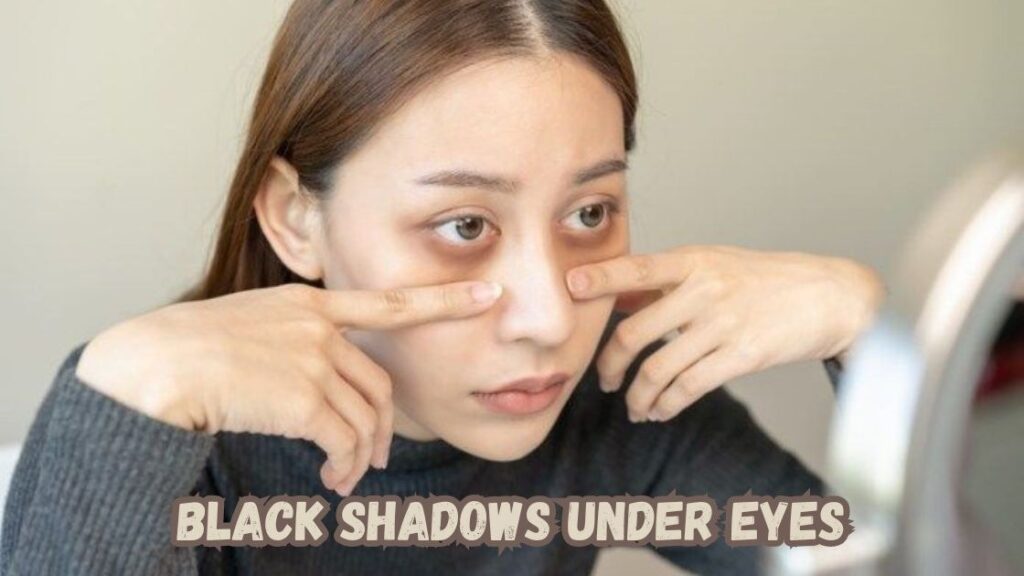 Black Shadows Under Eyes