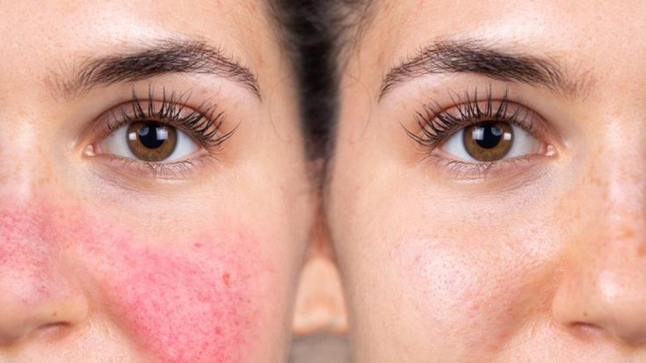 Skin Damage Application Example Best Ingredients for Damaged Skin Barrier: Repair and Restore Naturally ...