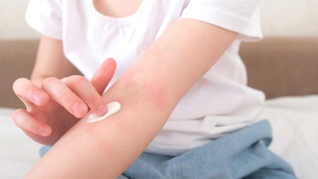 eczema-prone skin
