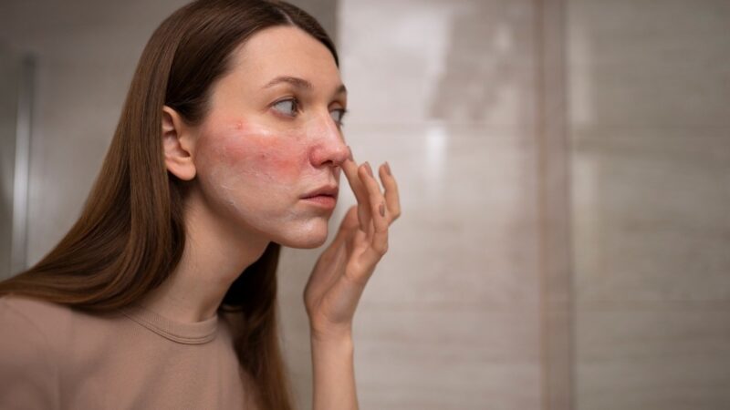 Circular Eczema on Face