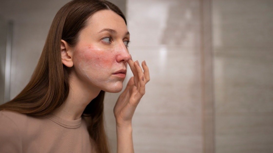 Circular Eczema on Face