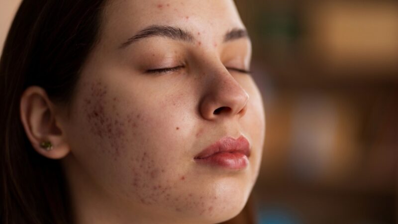 Hyper Even Dark Spot
